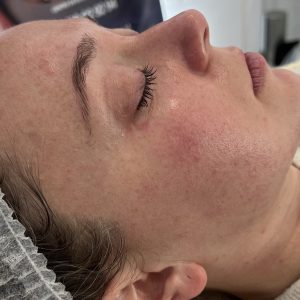 Limpieza facial profunda Ainhoa