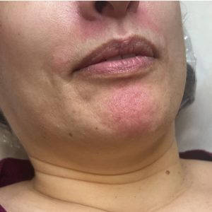 Dermapen Couperose o Telangiectasias