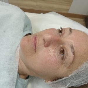 Ice Plasma Tratamiento Facial Luminosidad