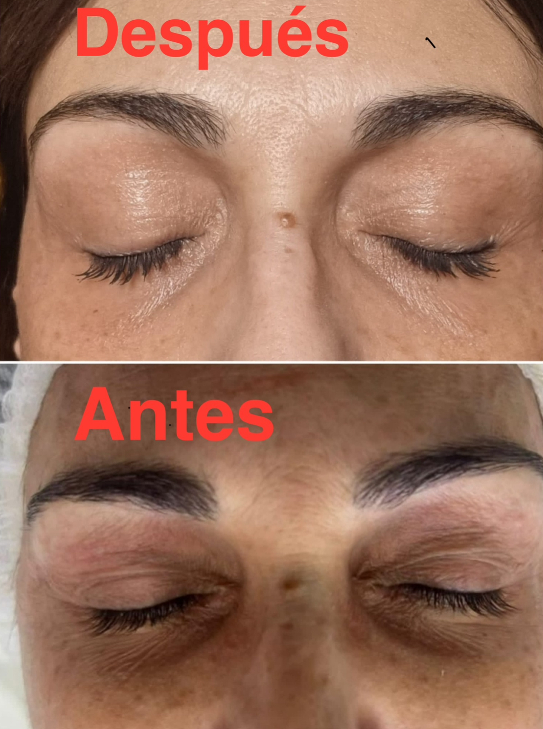 Hot Plasma Tratamiento Manchas de las Manos - Imagen 2