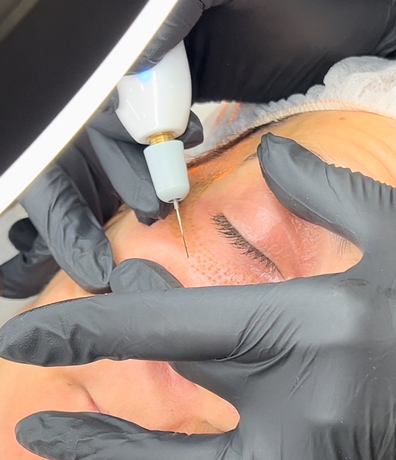 Hot Plasma Blefarolifting Inferior con Patas de Gallo