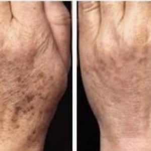 Hot Plasma Tratamiento Manchas de las Manos