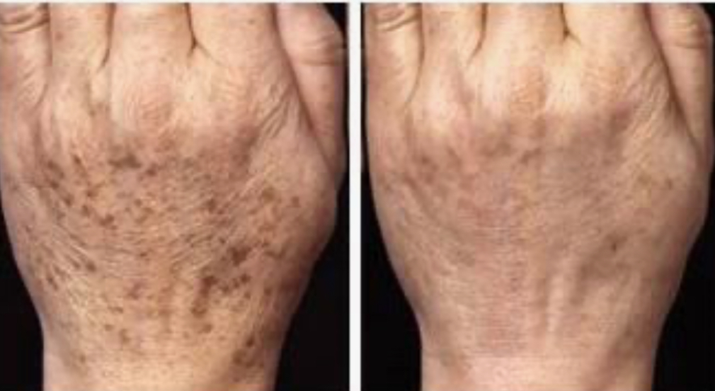 Hot Plasma Tratamiento Manchas de las Manos