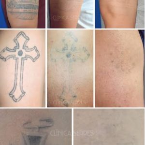 ELIMINACIÓN DE TATUAJES CON LÁSER