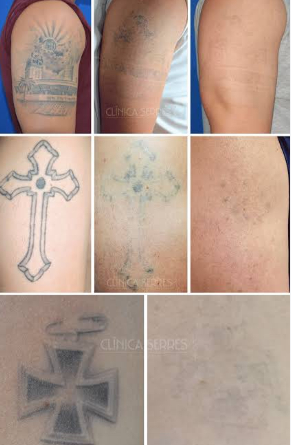 ELIMINACIÓN DE TATUAJES CON LÁSER