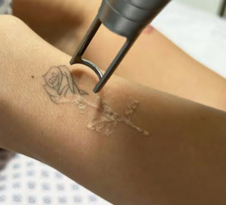 ELIMINACIÓN DE TATUAJES CON LÁSER - Imagen 2